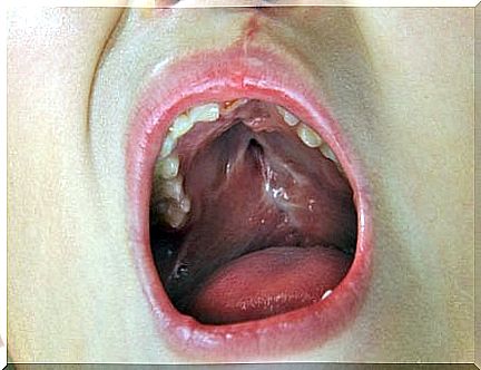 A child's cleft palate - everything you need to know