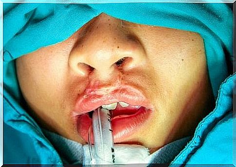 Child's cleft palate