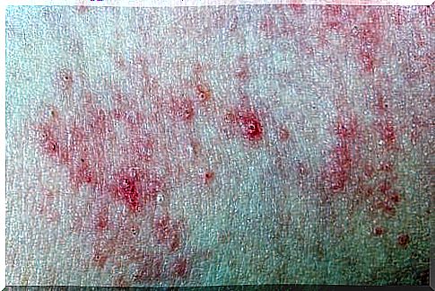 Chronic urticaria in children