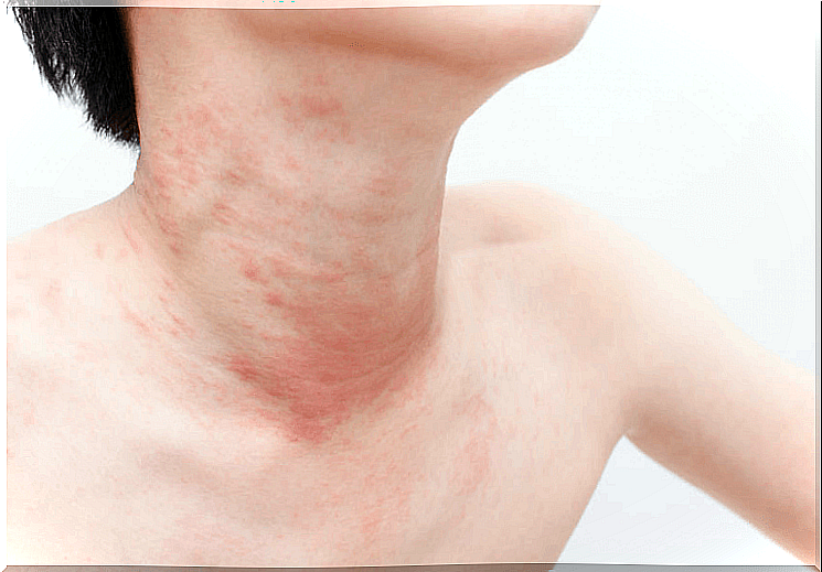 Causes of chronic urticaria in children