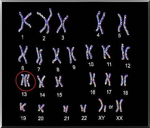 Patau syndrome or trisomy 13