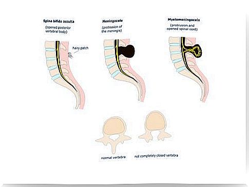 Spina bifida